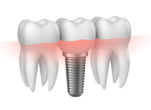 Prothèse dentaire sur implant
